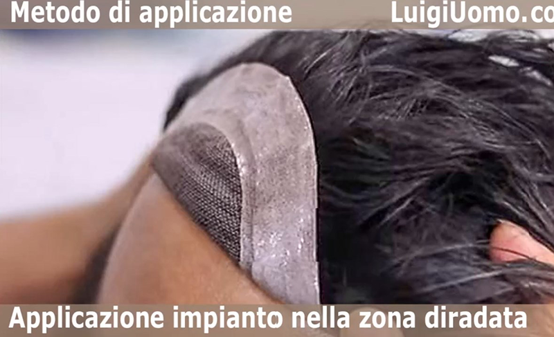 Trapianto Capelli Non Chirurgico Patch Cutanea